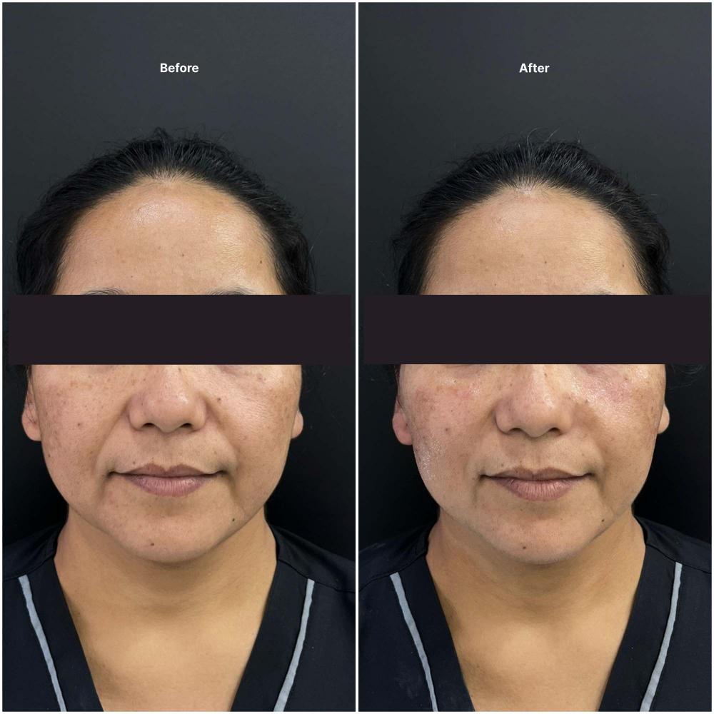 Botox result KOQ10